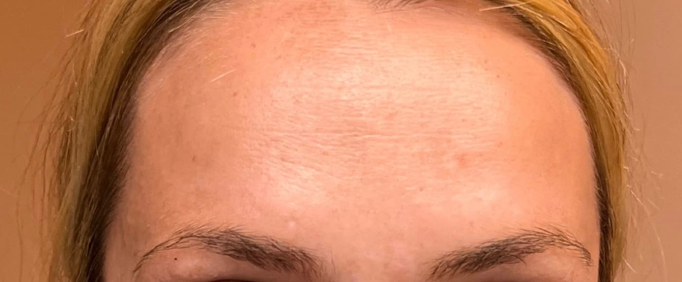Anti-wrinkle treatments — after