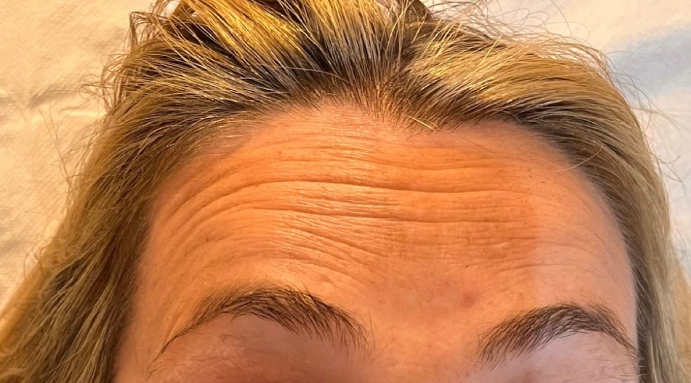Anti-wrinkle treatments — before