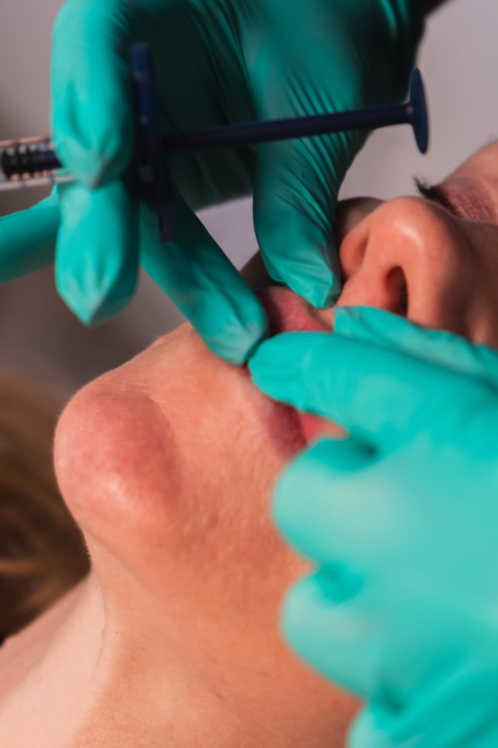 Dermal filler artistry