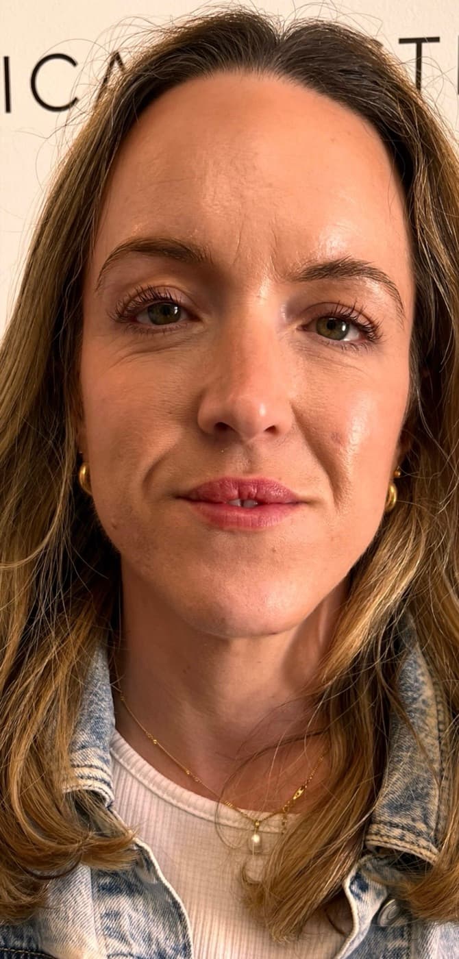Dermal fillers — after