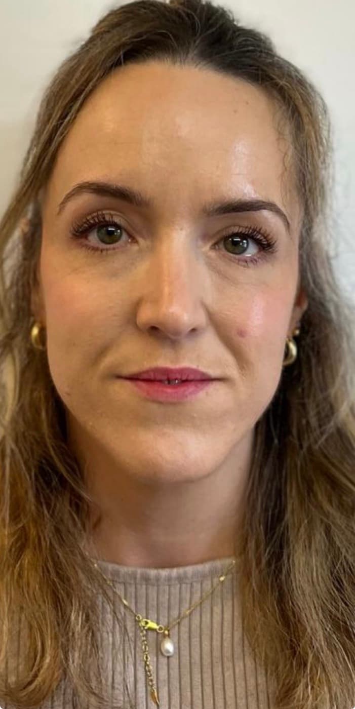 Dermal fillers — before