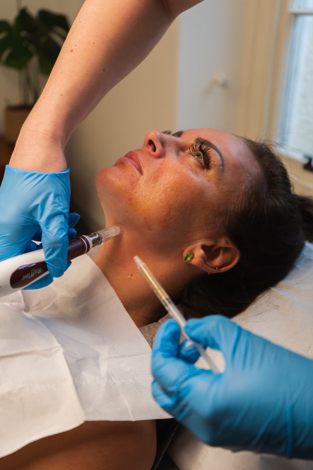 Microneedling