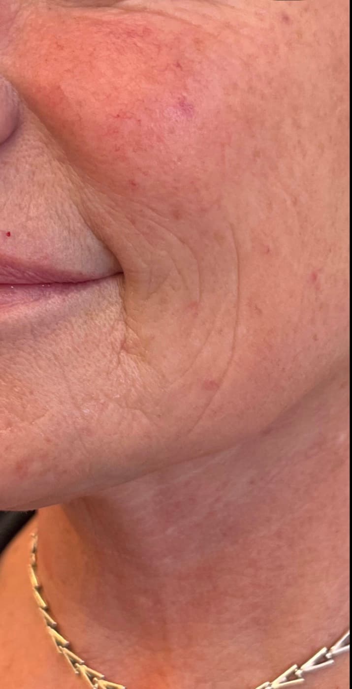 Skin boosters — after