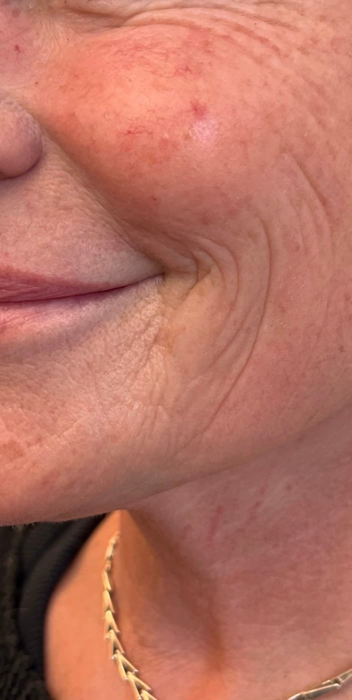 Skin boosters — before
