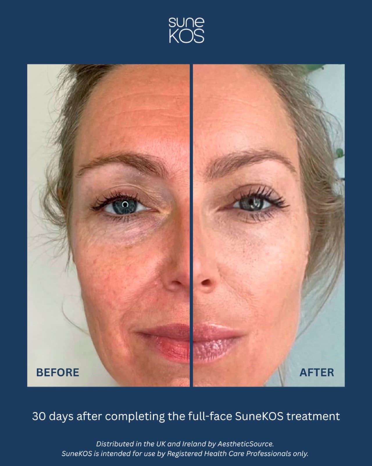 suneKOS treatment at JONES Skin and Wellness