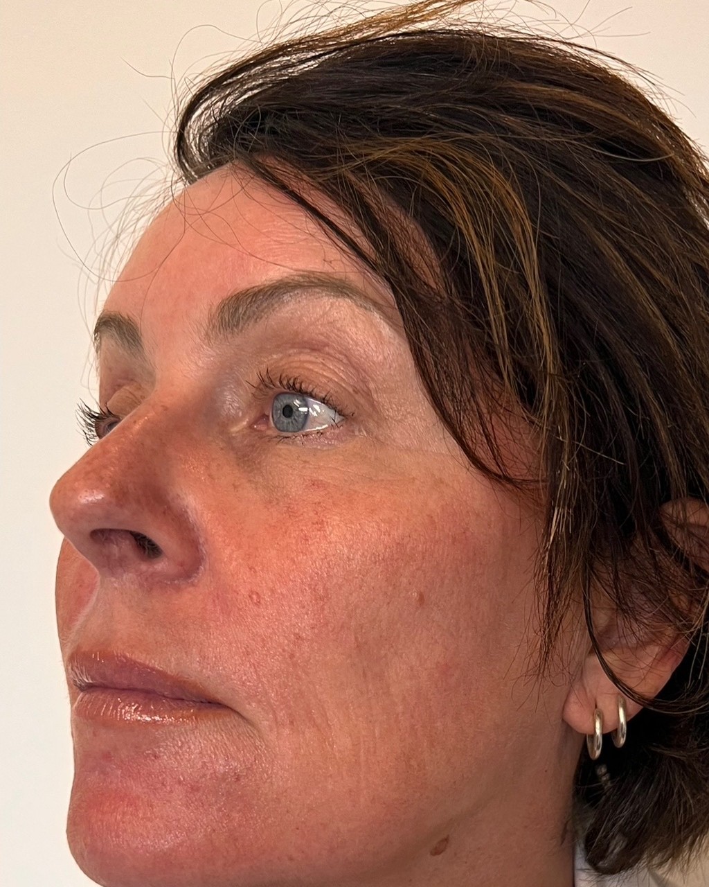 After Sculptra treatment