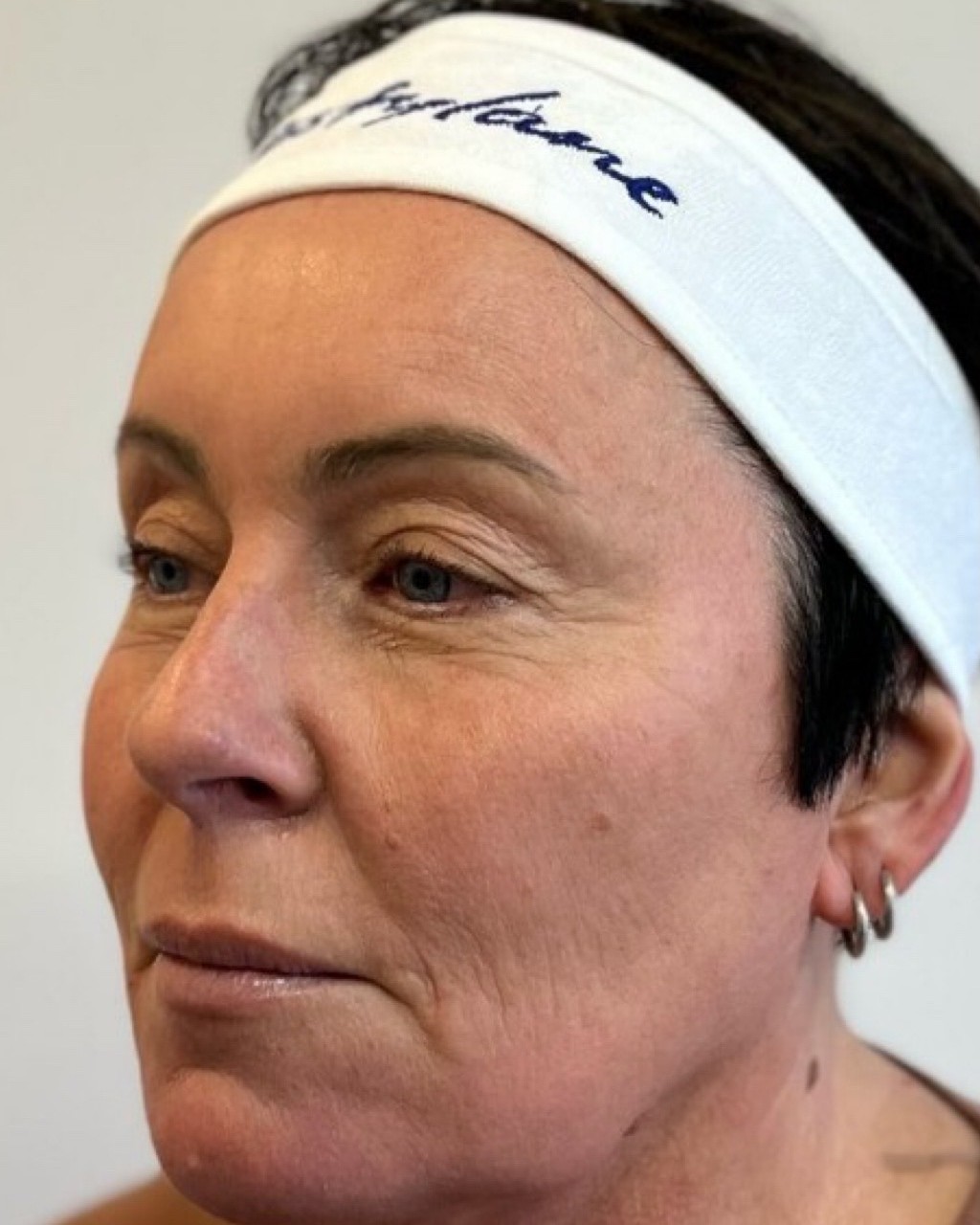 Before Sculptra treatment